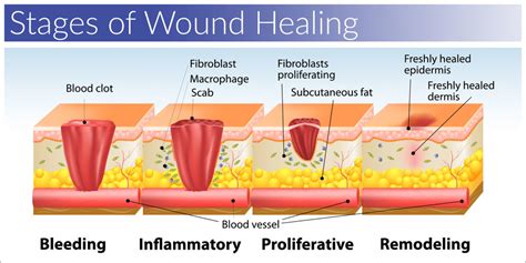 Healing Wounds Naturally with Homeopathic Remedies